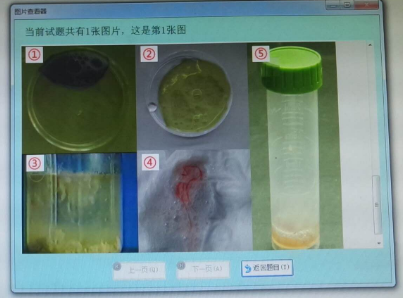 如图所示,符合支气管扩张患者静置后的痰液特征的是