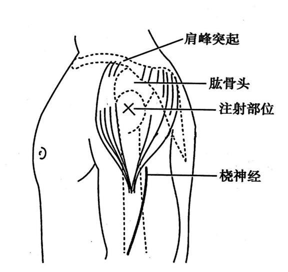 护士遵医嘱为患者进行药物注射,注射部位如图示,请问该种注射方式为