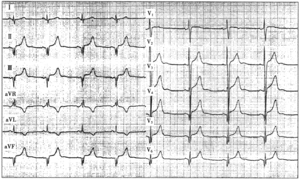 异常心电图 q波图片